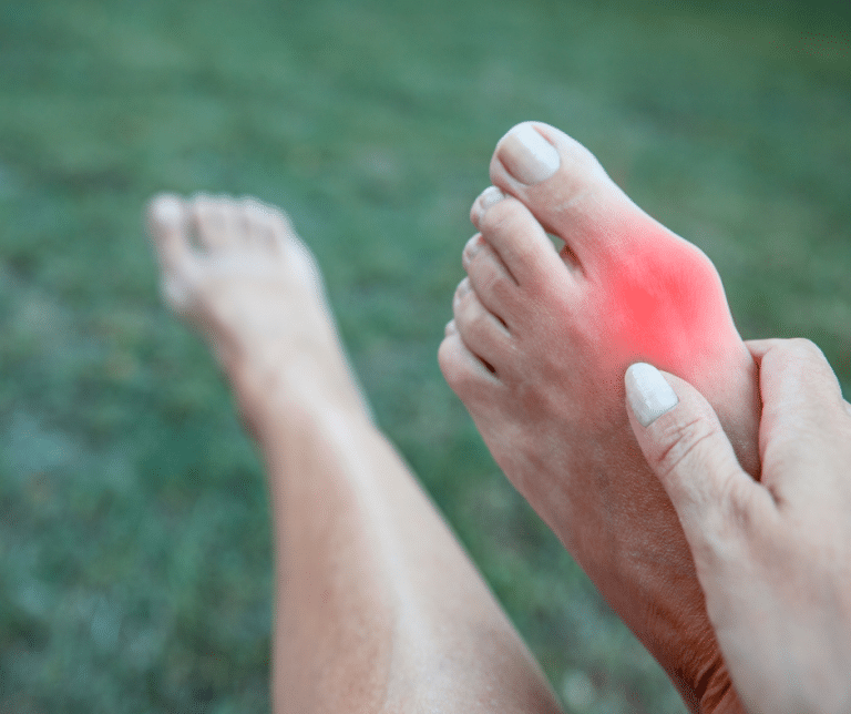 Treating Bunions