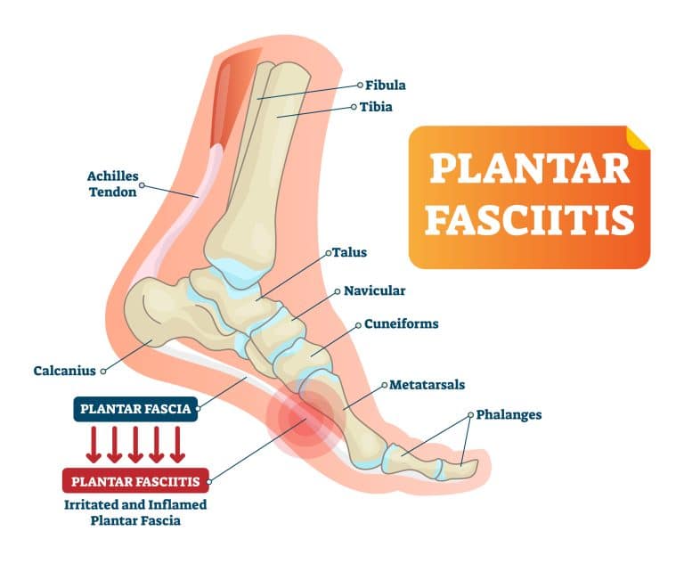 What are Plantar Fasciitis Symptoms, Causes, and Treatment?