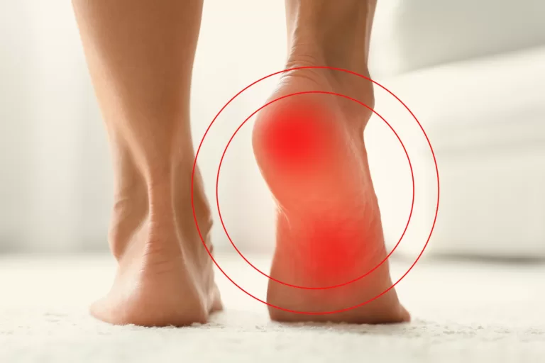 Heel Pain - Elite Foot Care Sunshine Coast Podiatrists