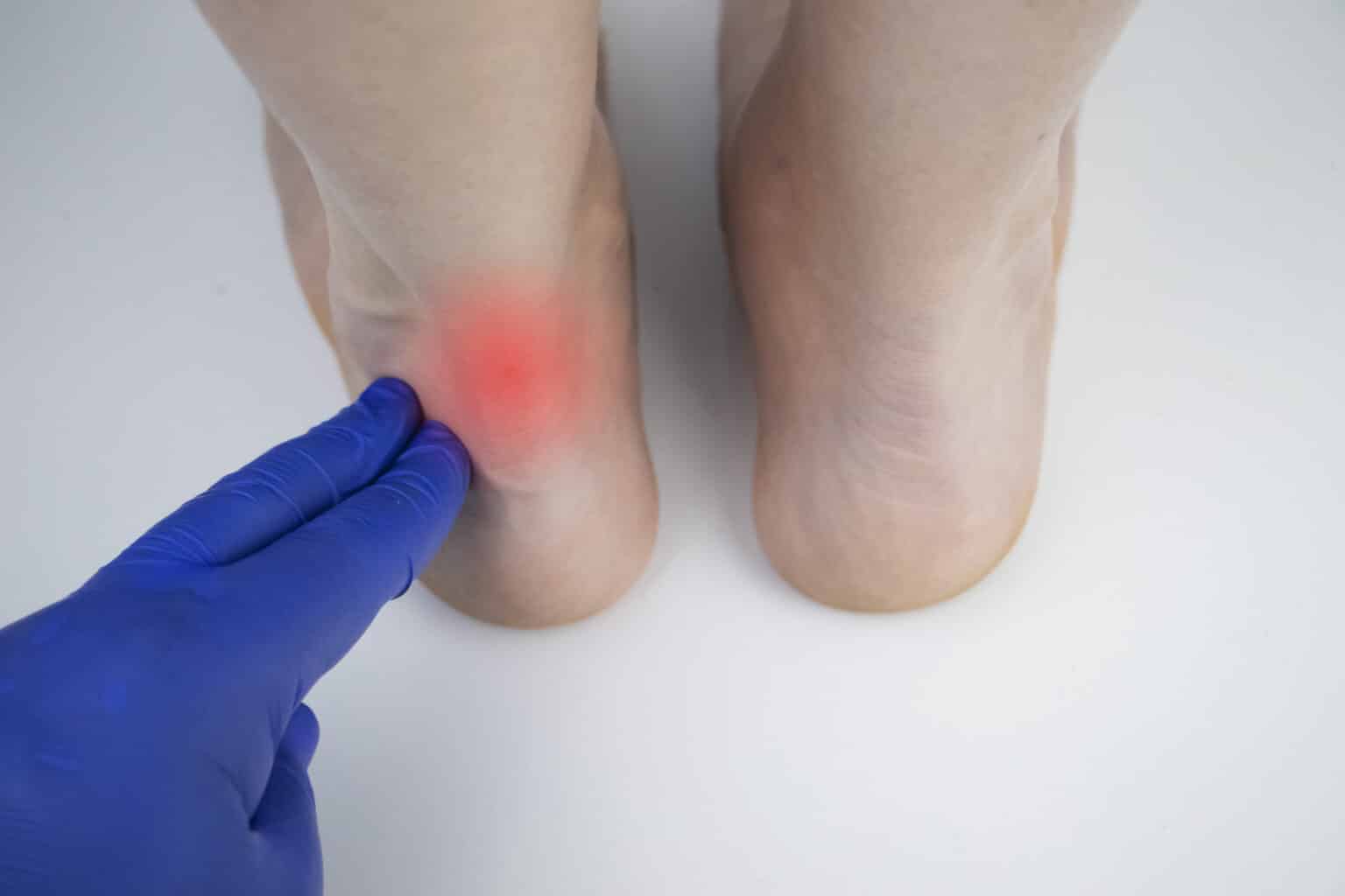 Beule An Der Ferse Hinten elitefootcare.com.au