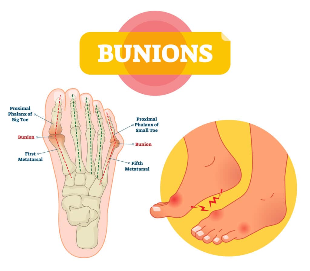 Bunions - Elite Foot Care