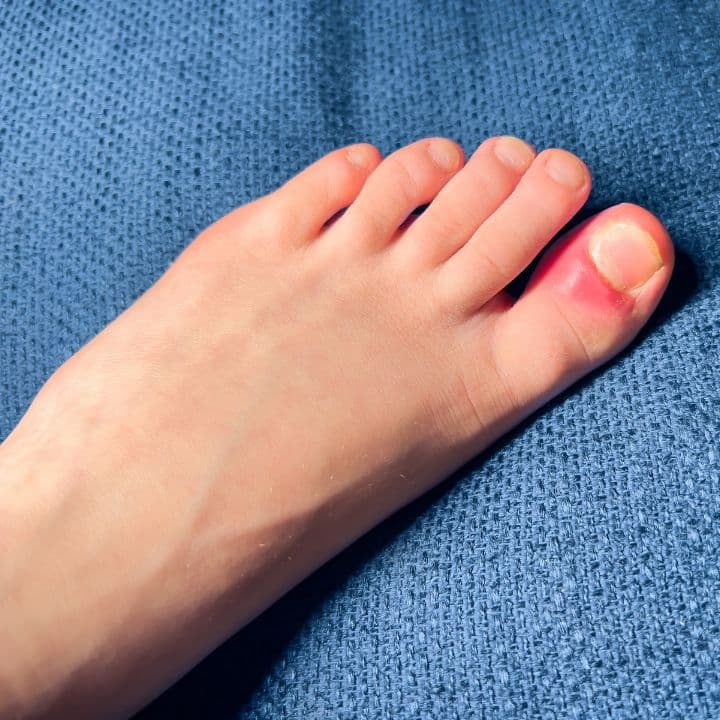 Ingrown Toenails - Elite Foot Care Sunshine Coast Podiatrists