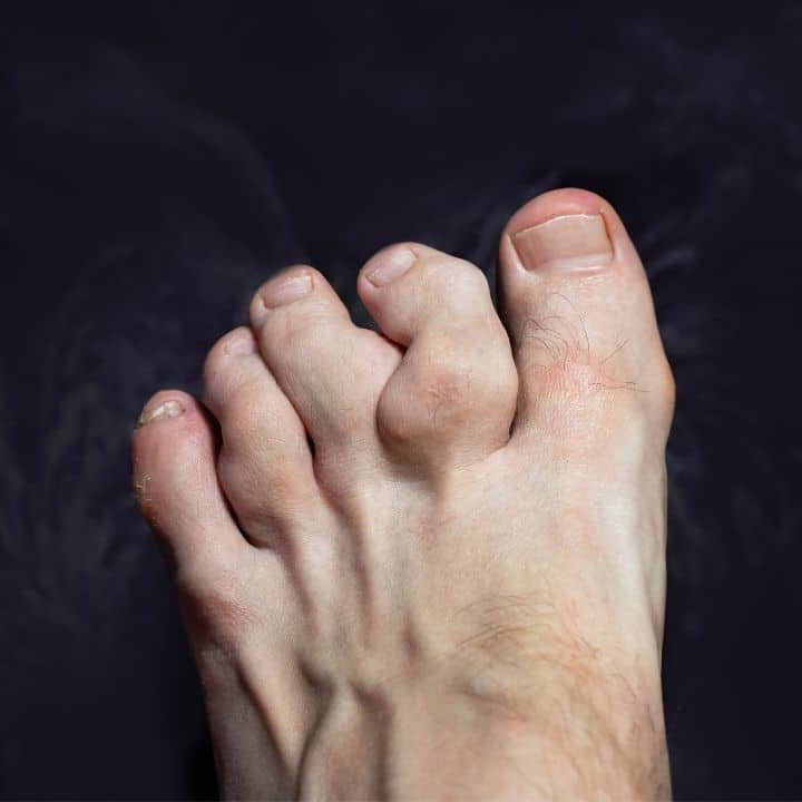 Hammertoe - Elite Foot Care Sunshine Coast Podiatrists