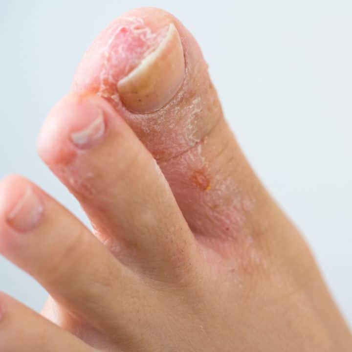 Athlete's Foot (Tinea) - Elite Foot Care Sunshine Coast Podiatrists