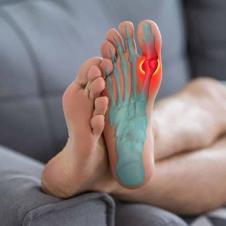 Gout - Elite Foot Care Sunshine Coast Podiatrists