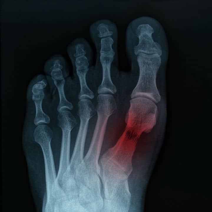 Lower Limb Fractures - Elite Foot Care - Sunshine Coast Podiatrists