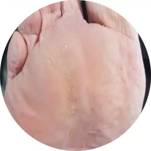 After Swift Microwave Wart Therapy - Elite Foot Care Sunshine Coast Podiatrists