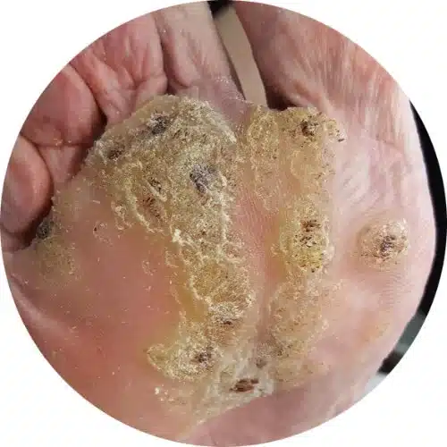 Before Swift Microwave Wart Therapy - Elite Foot Care Sunshine Coast Podiatrists